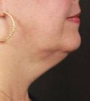 Ultherapy<sup>®</sup> Before and After Case 3 Before