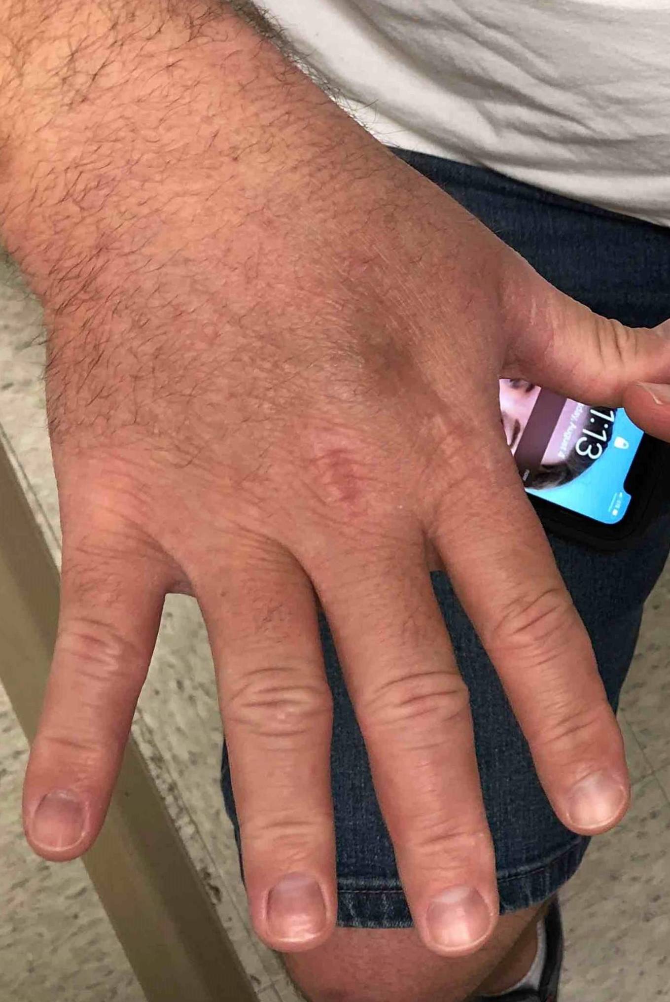 Atopic Dermatitis (6 Month Dupixent) Case-30 After