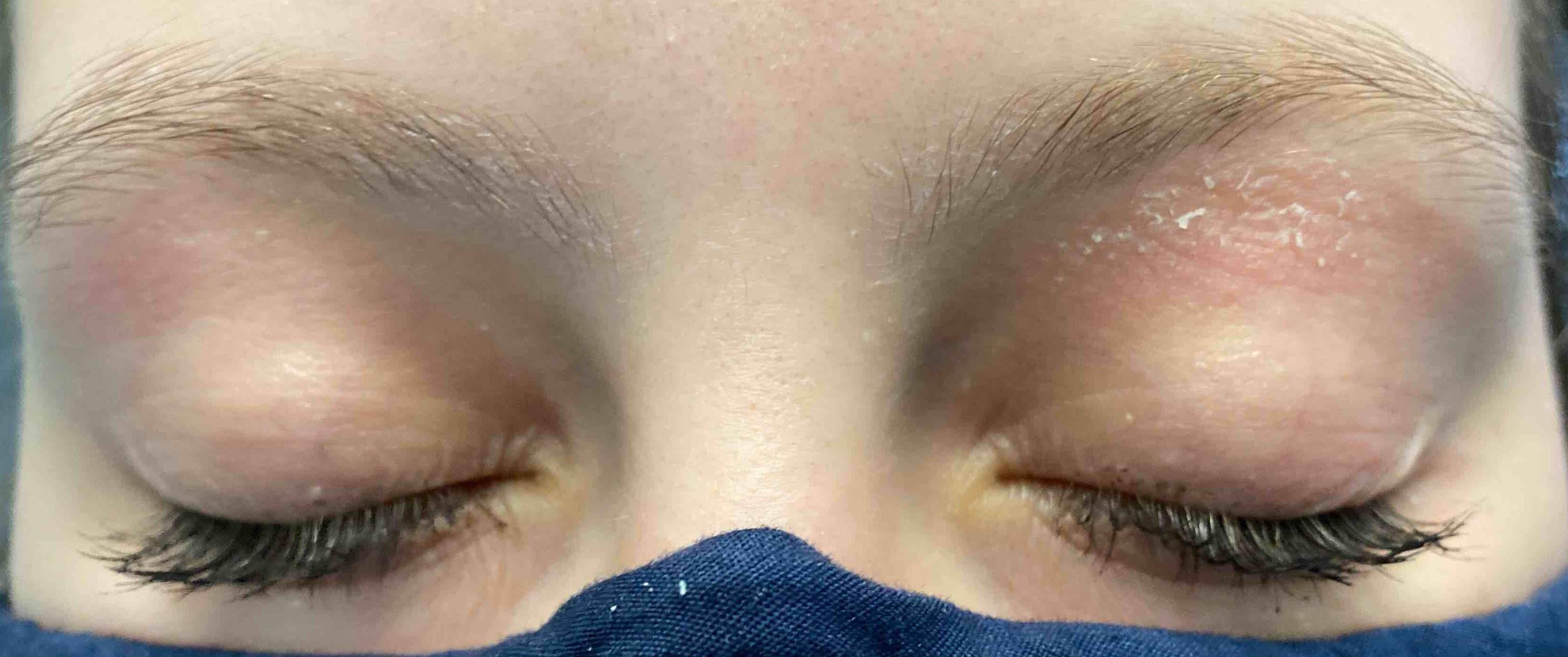 Atopic Dermatitis (6 Month Dupixent) Case-32 Before