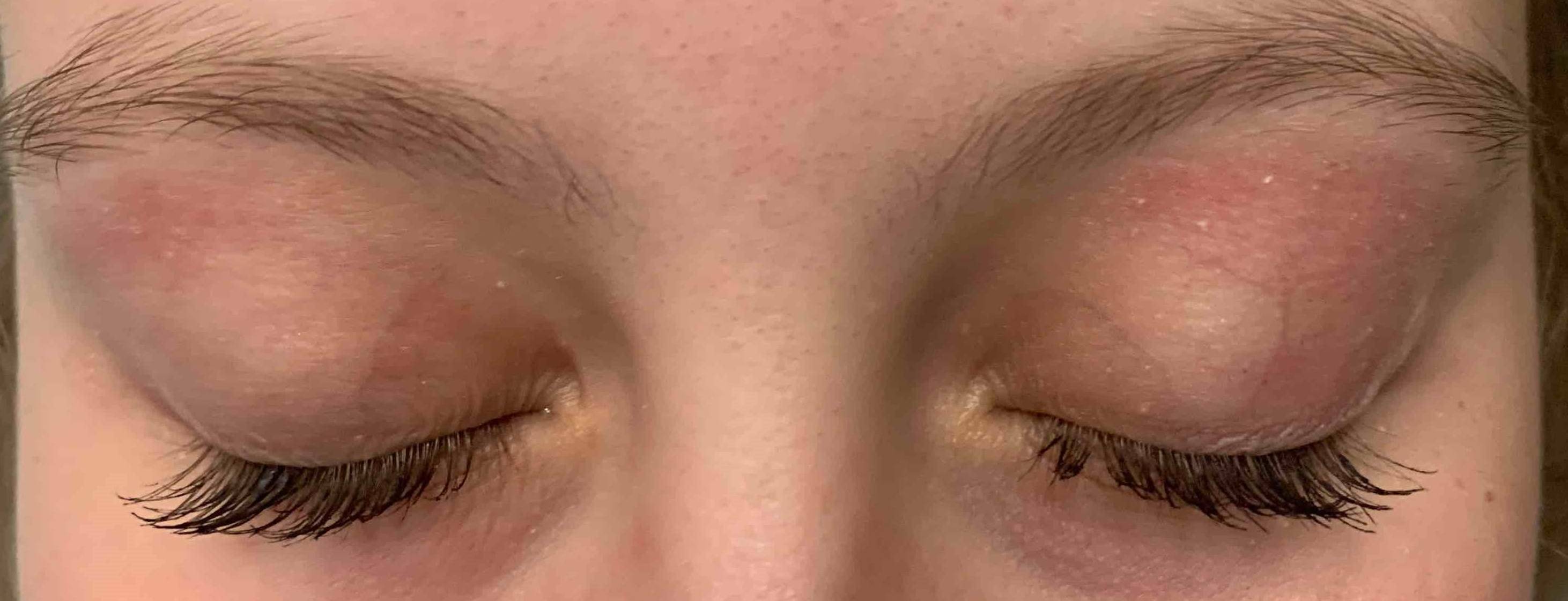 Atopic Dermatitis (6 Month Dupixent) Case-32 After