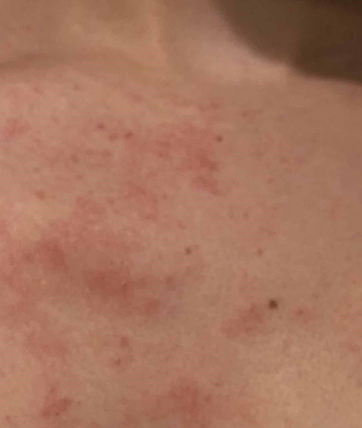 Atopic Dermatitis (6 Month Dupixent) Case-33 Before