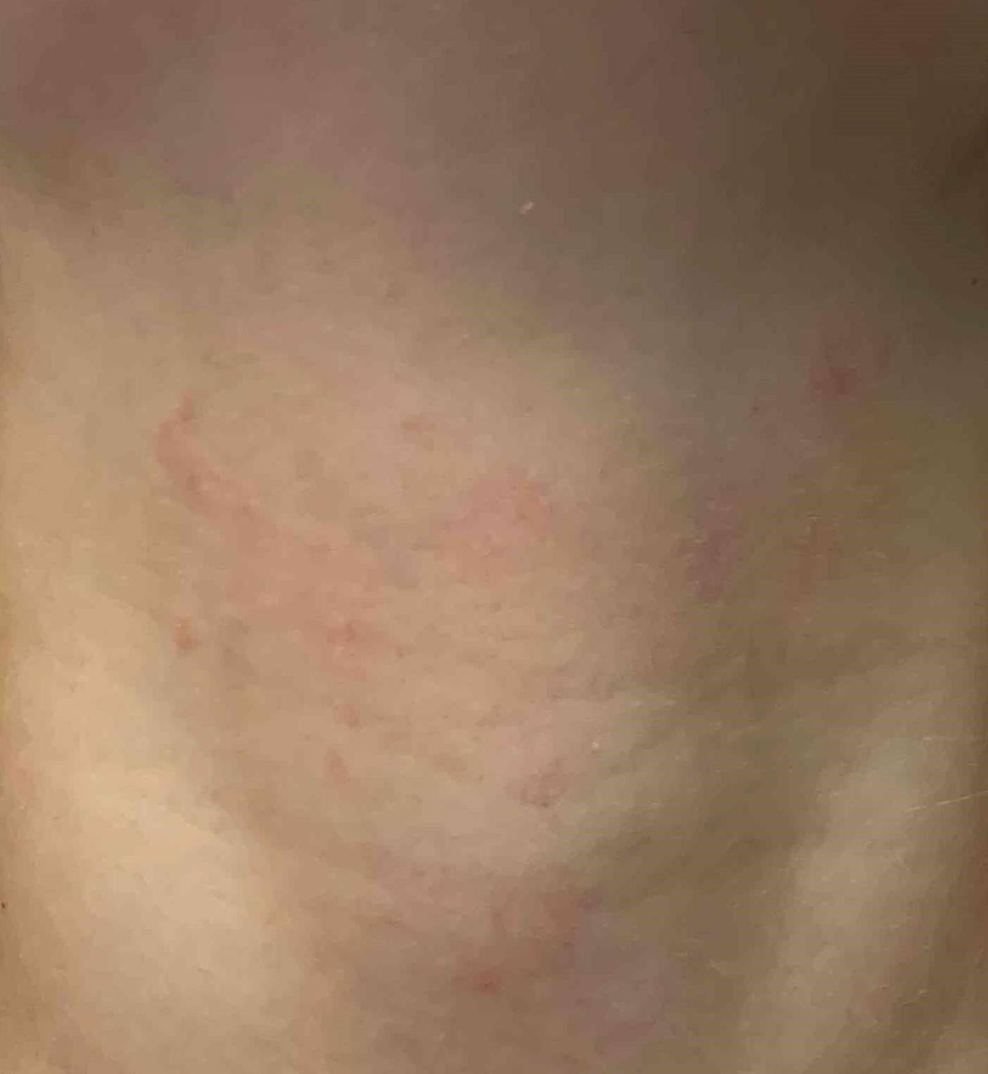 Atopic Dermatitis (6 Month Dupixent) Case-33 After