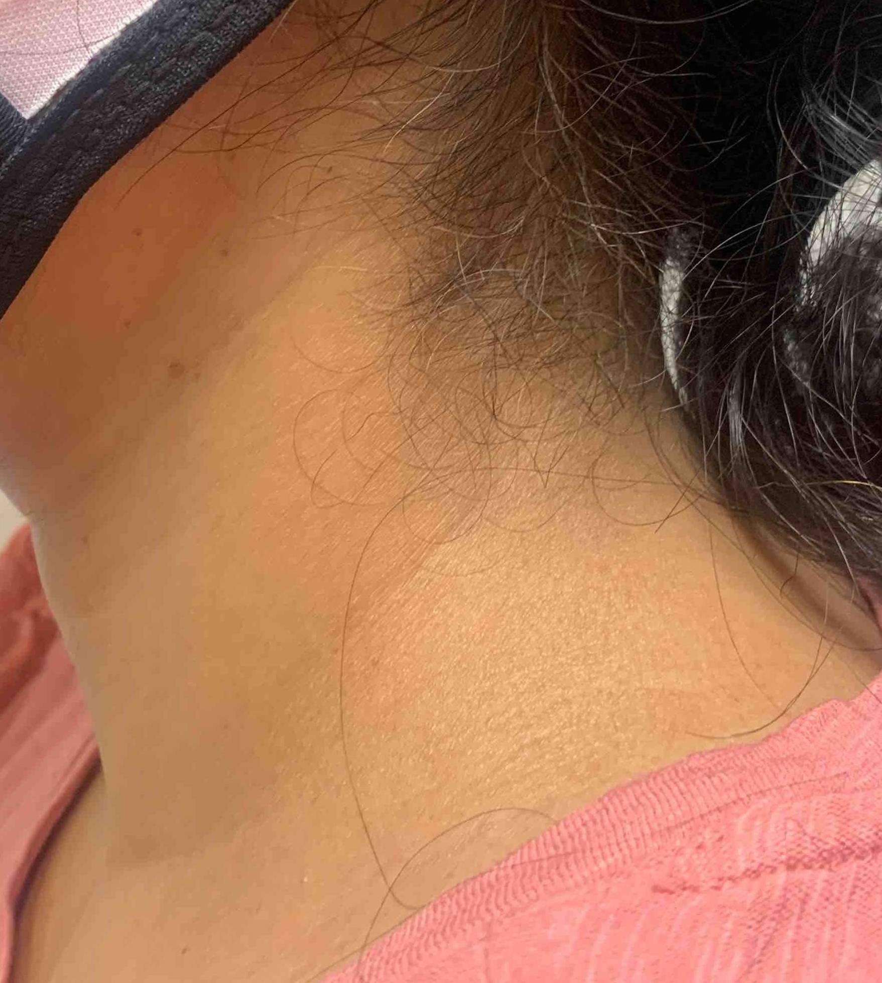 Atopic Dermatitis (6 Month Dupixant) Case-34 After