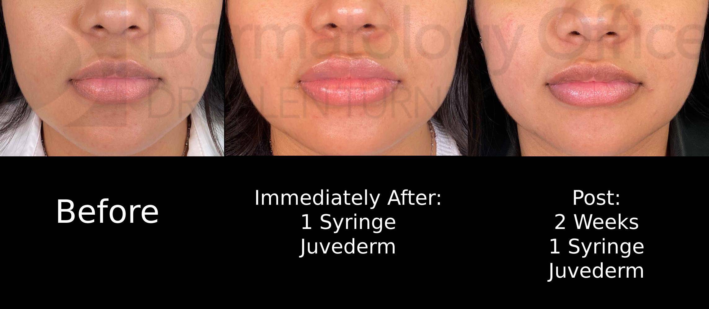 Juvederm (1 Syringe) Case-24 