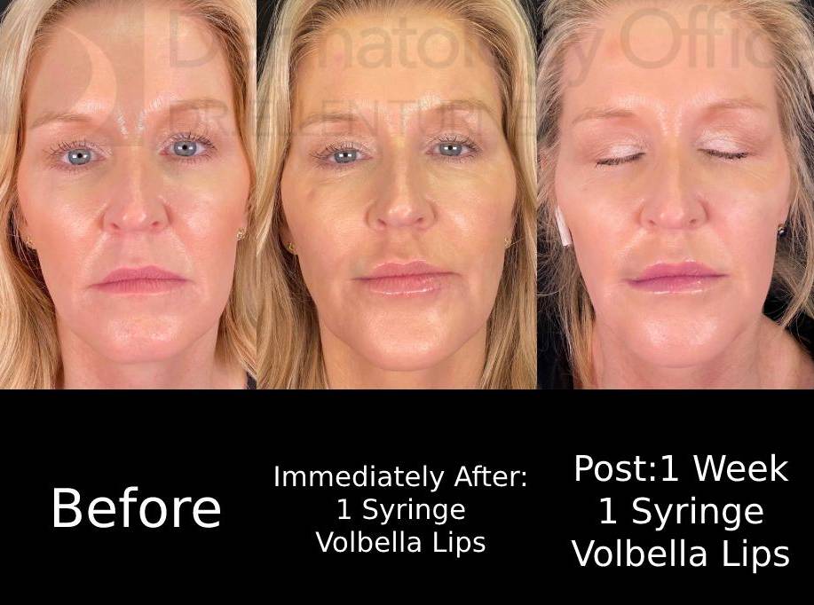 Volbella (1 Syringe) Case-8 