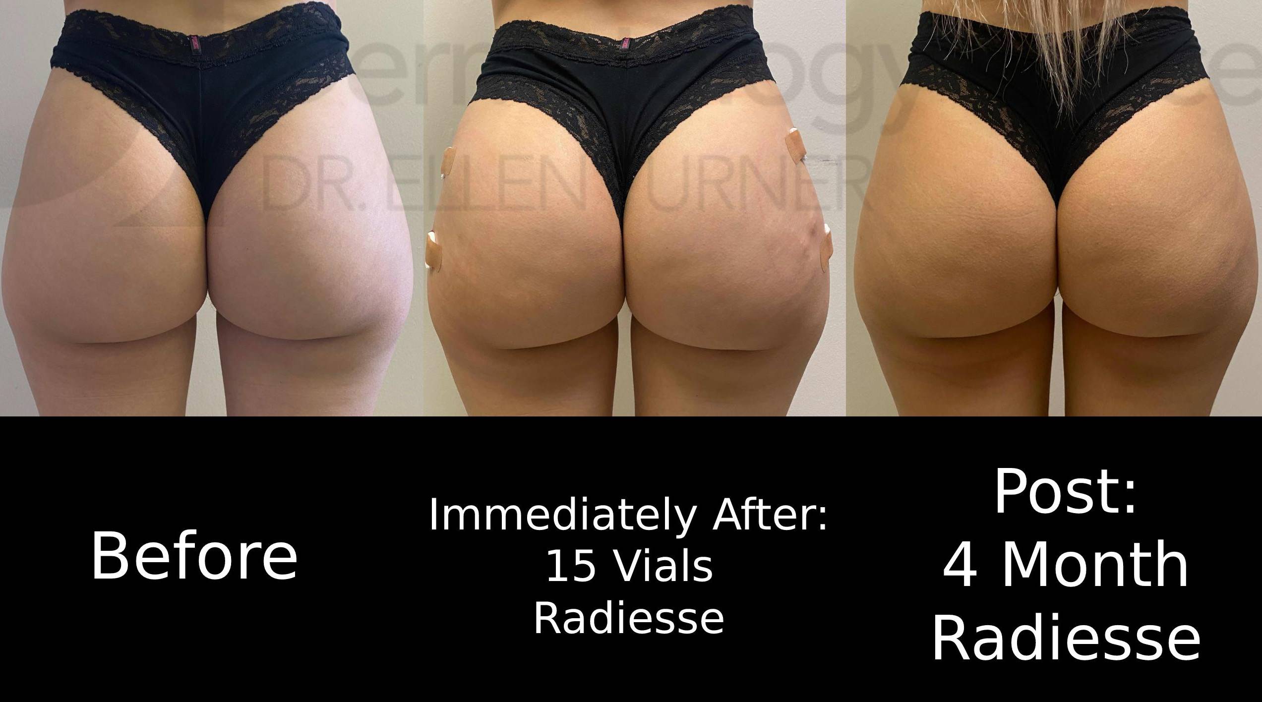 Radiesse (15 syringes) Case 12 