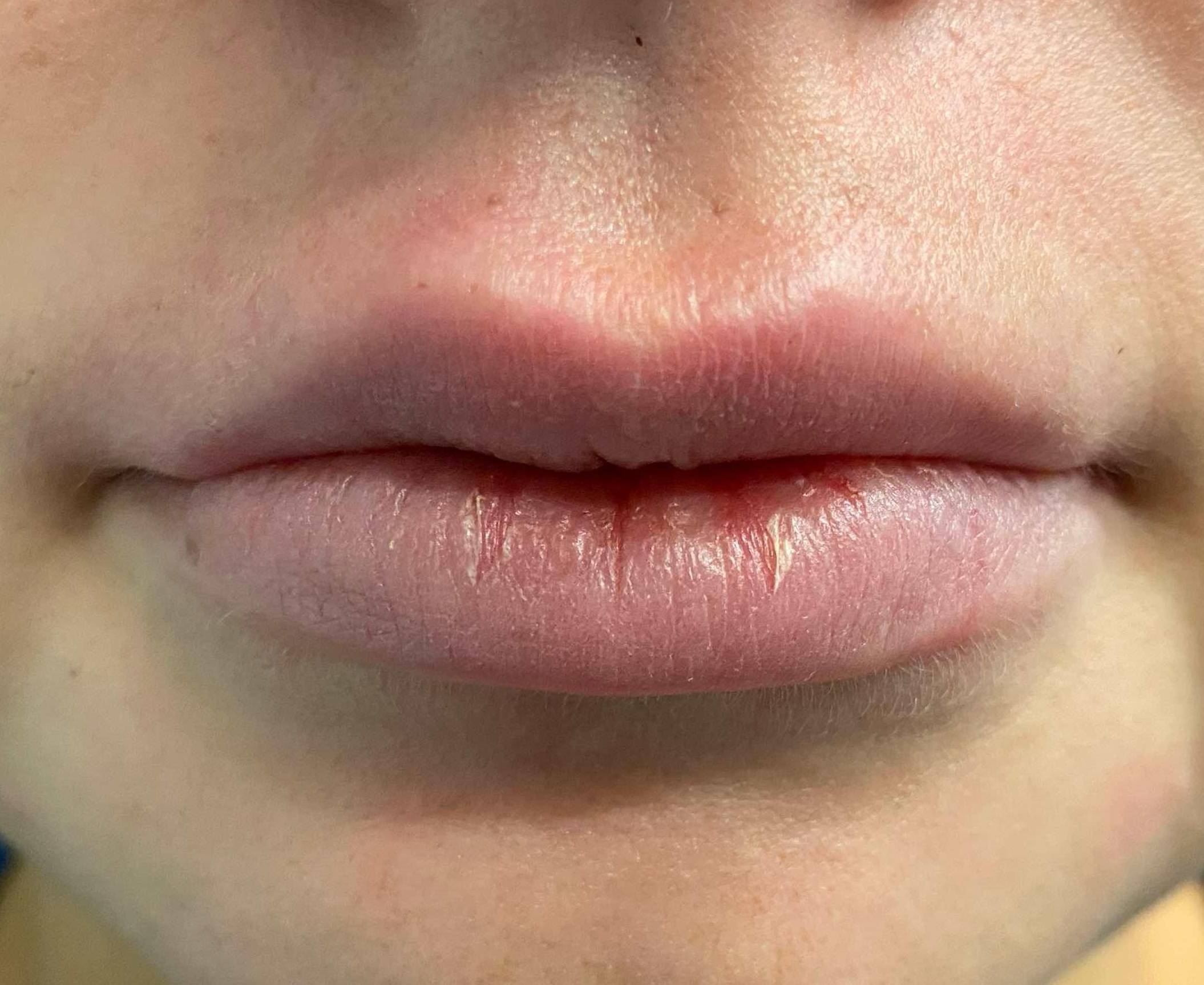 Juvederm (1 Syringe) Case-28 Before
