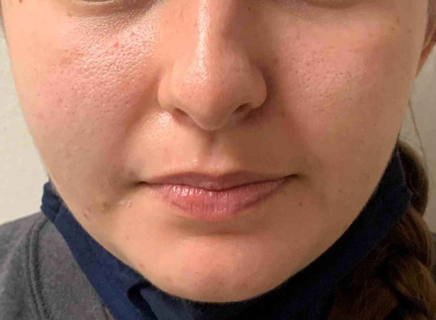 Acne Before and After Case 20 Before