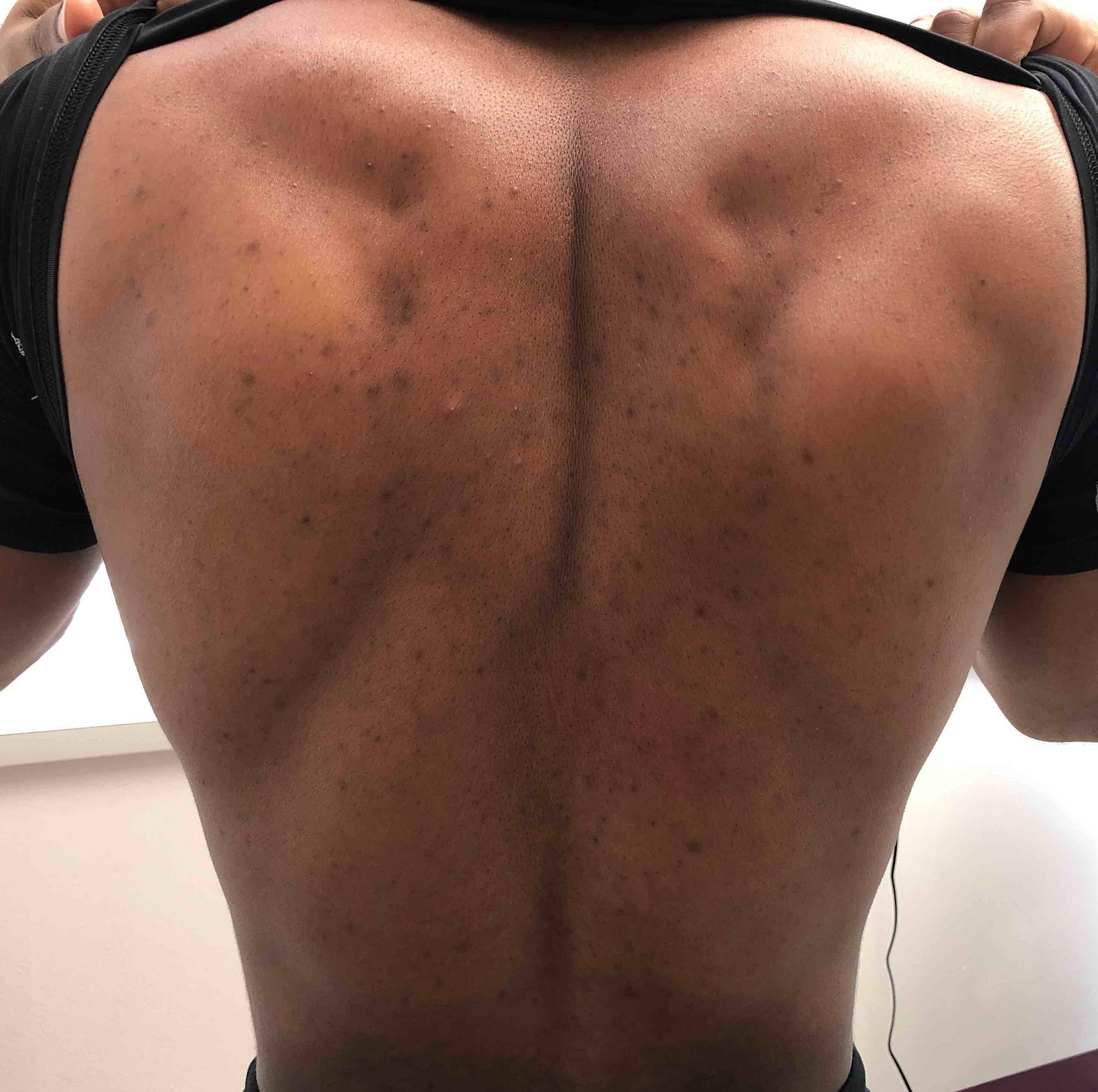 Acne Before and After Case-21 Before
