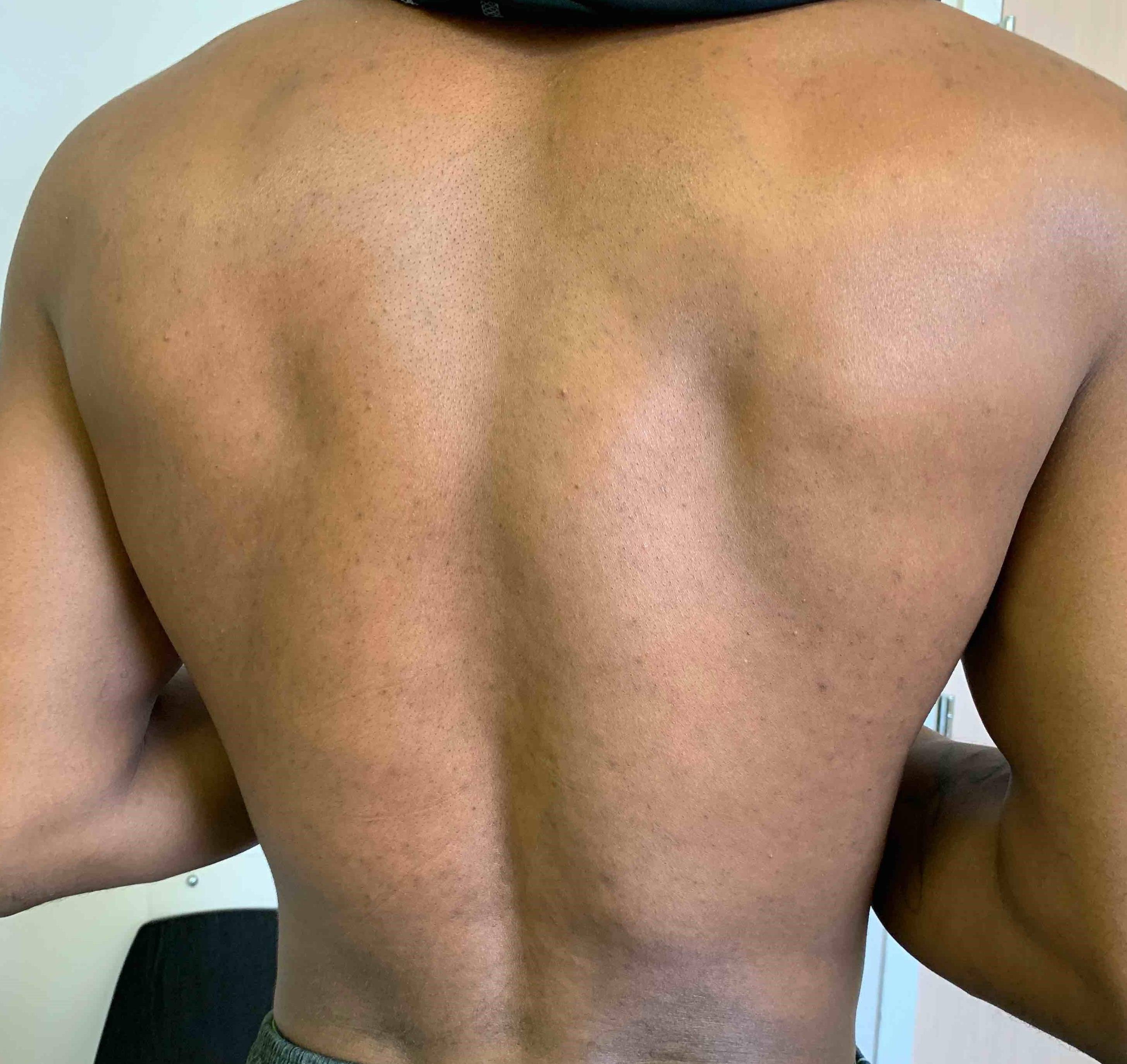 Acne Before and After Case-21 After