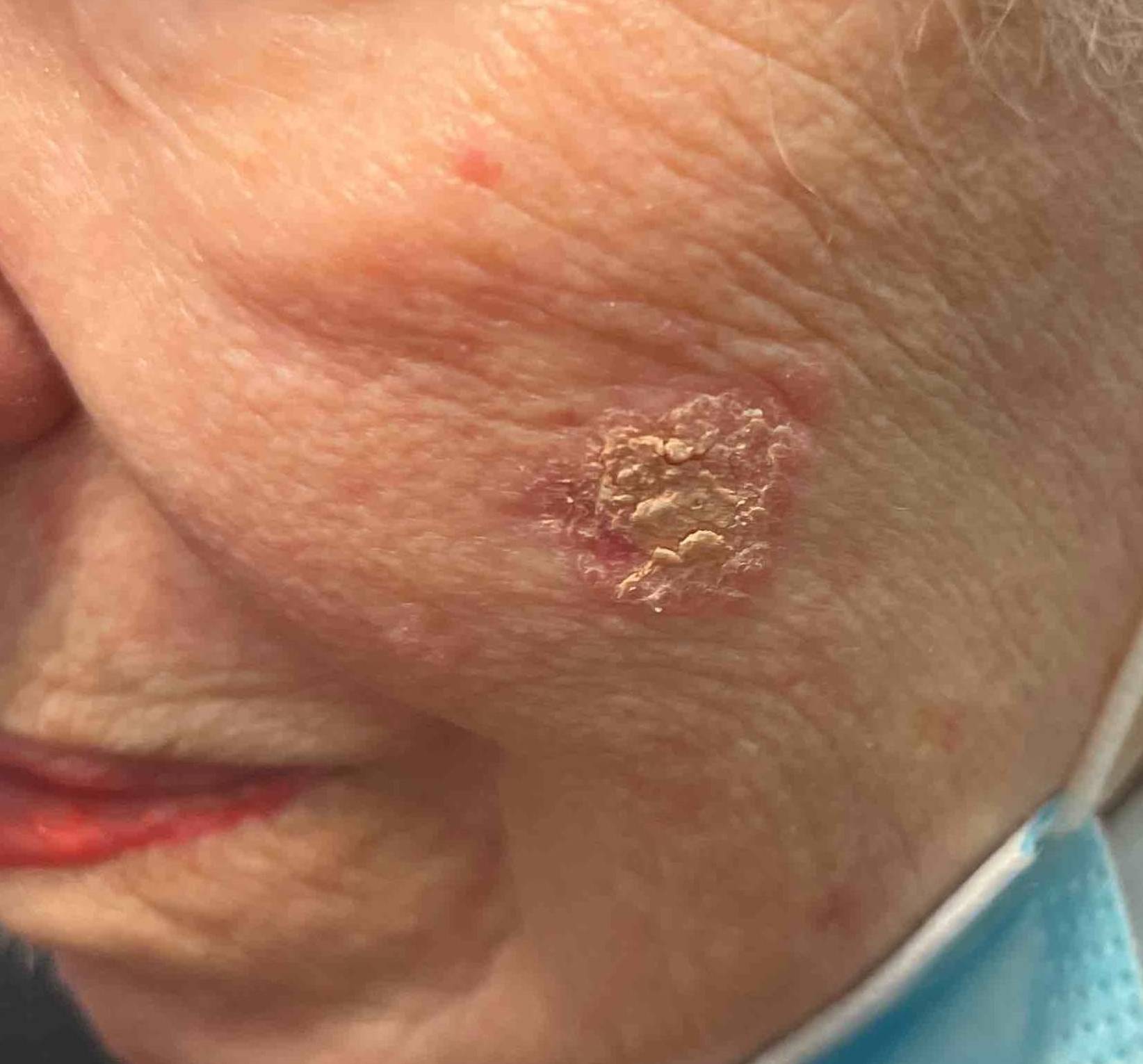 Actinic Keratosis Case-1 Before