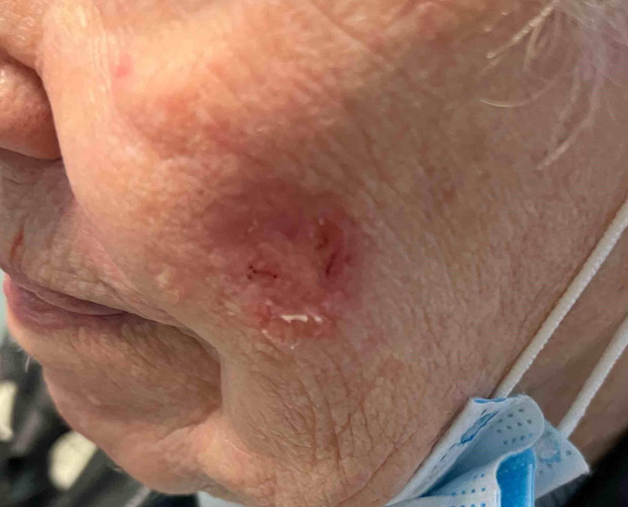 Actinic Keratosis Case-1 After