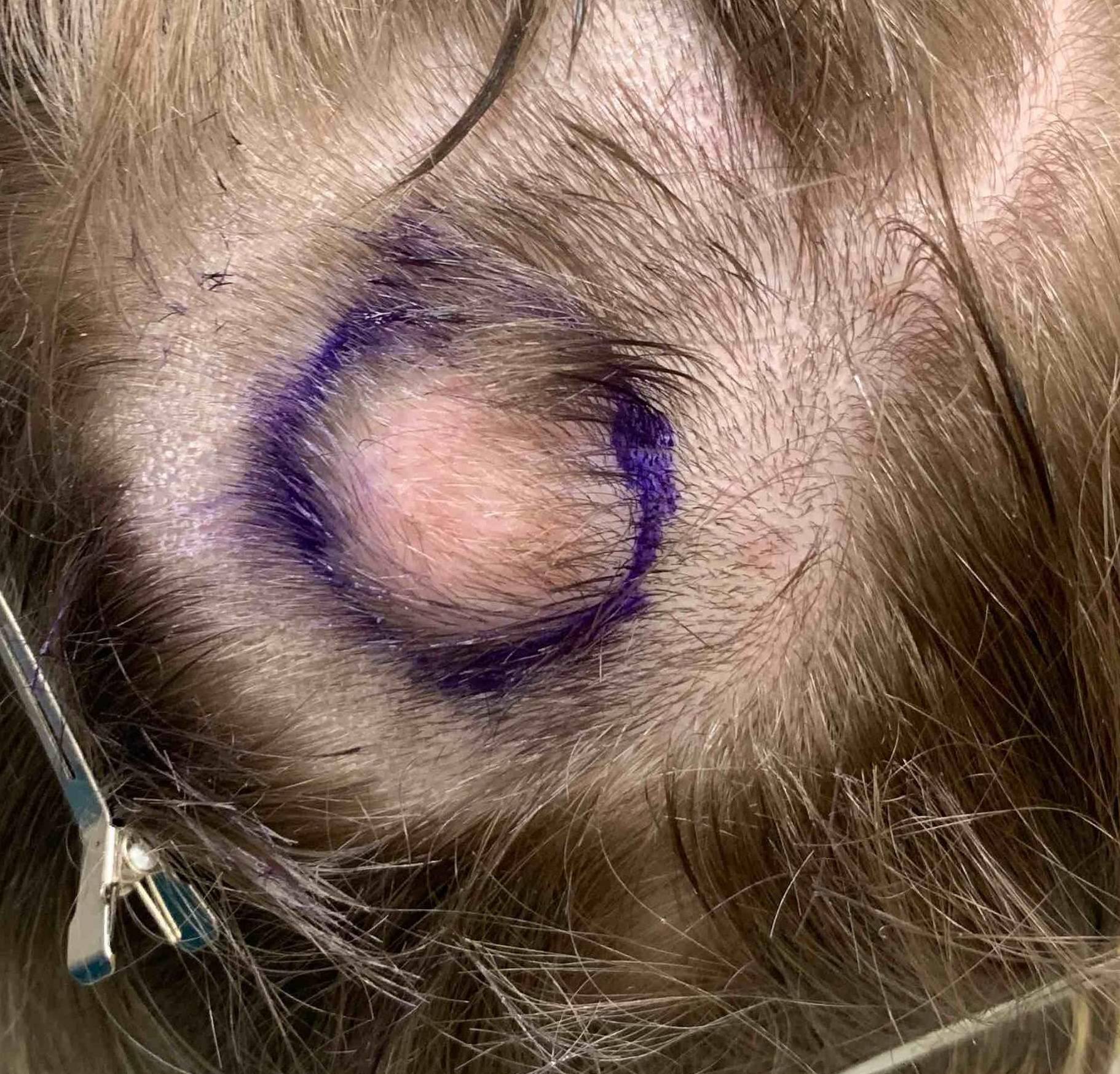 Cyst Removal Before and After Case-9 Before