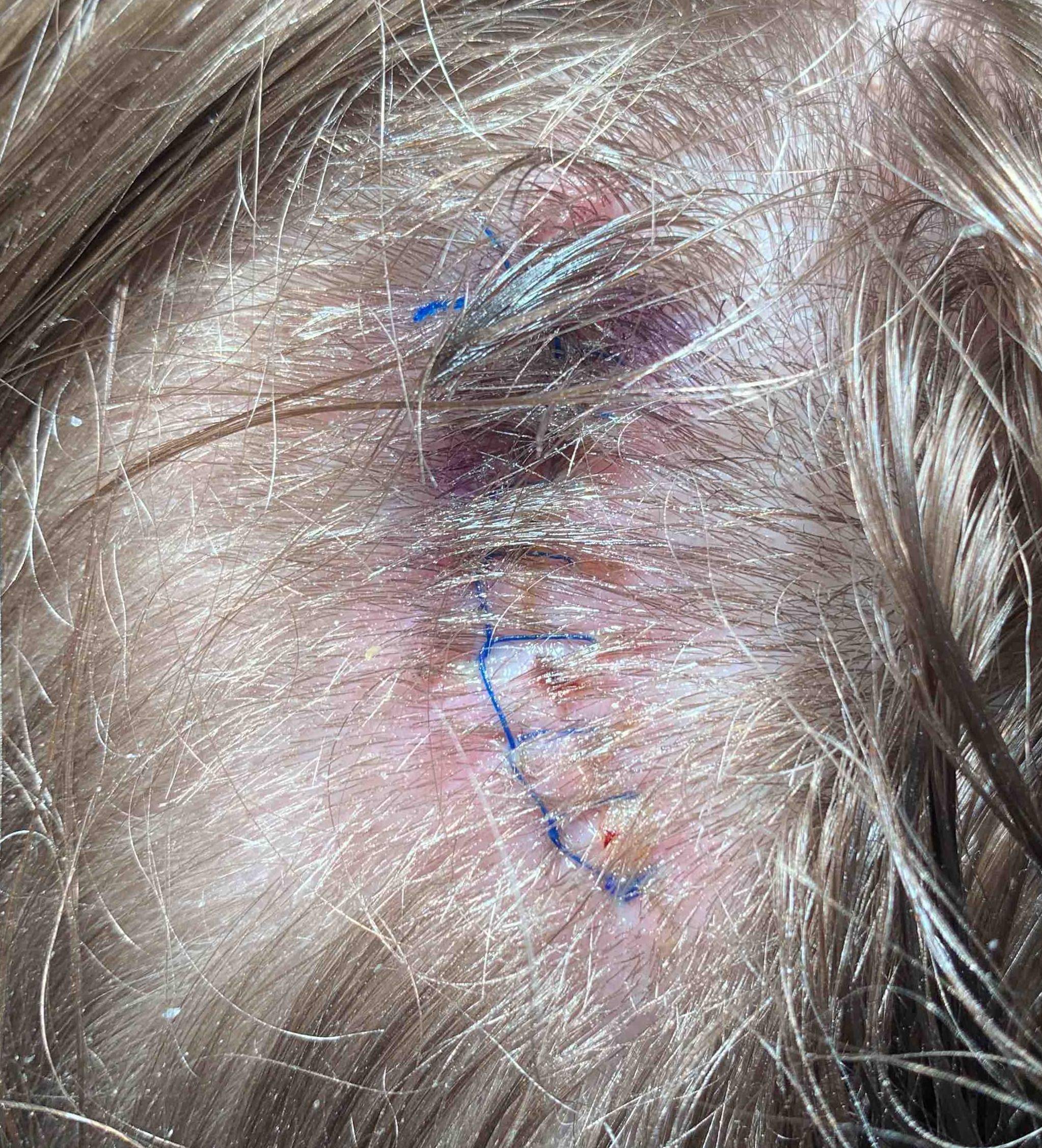 Cyst Removal Before and After Case-9 After