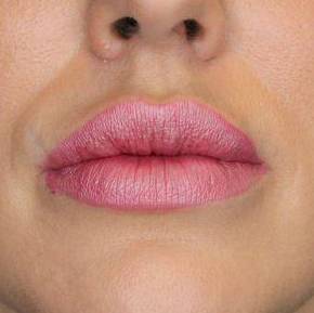 Juvederm (2 Syringes) Case-4 After