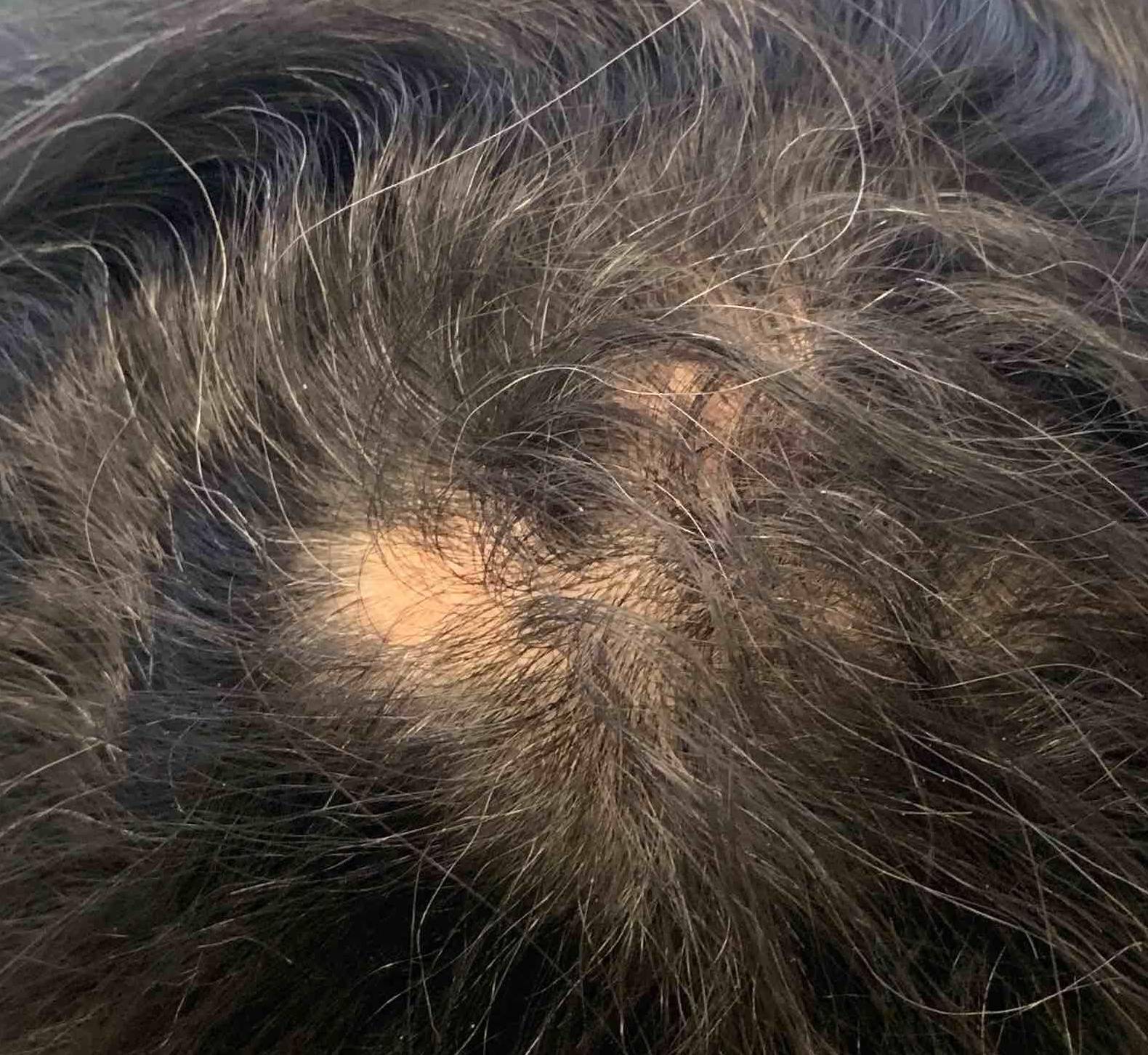 Hair loss Before and After Case 10 After