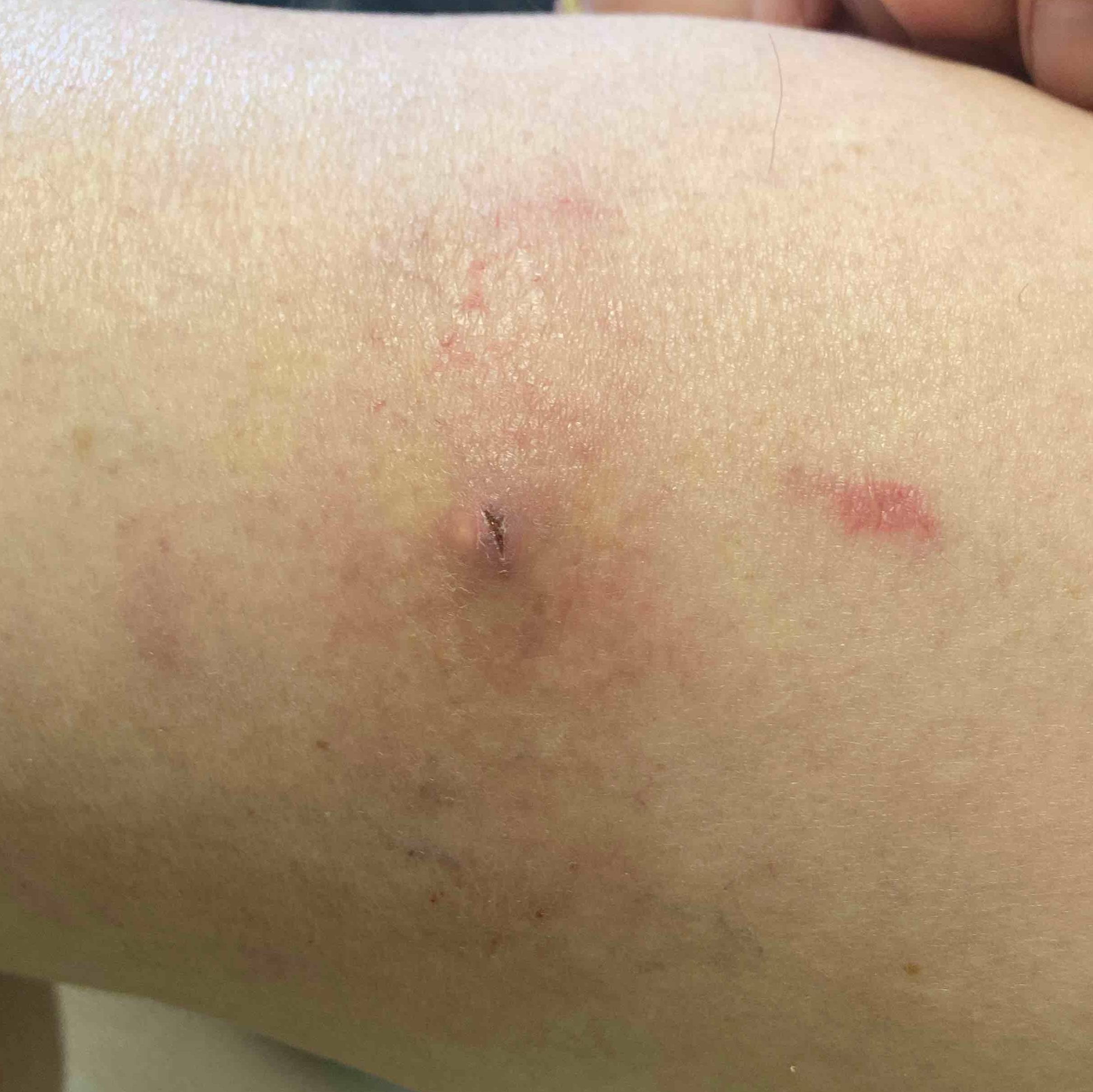 Cyst Removal Before and After Case-10 Before