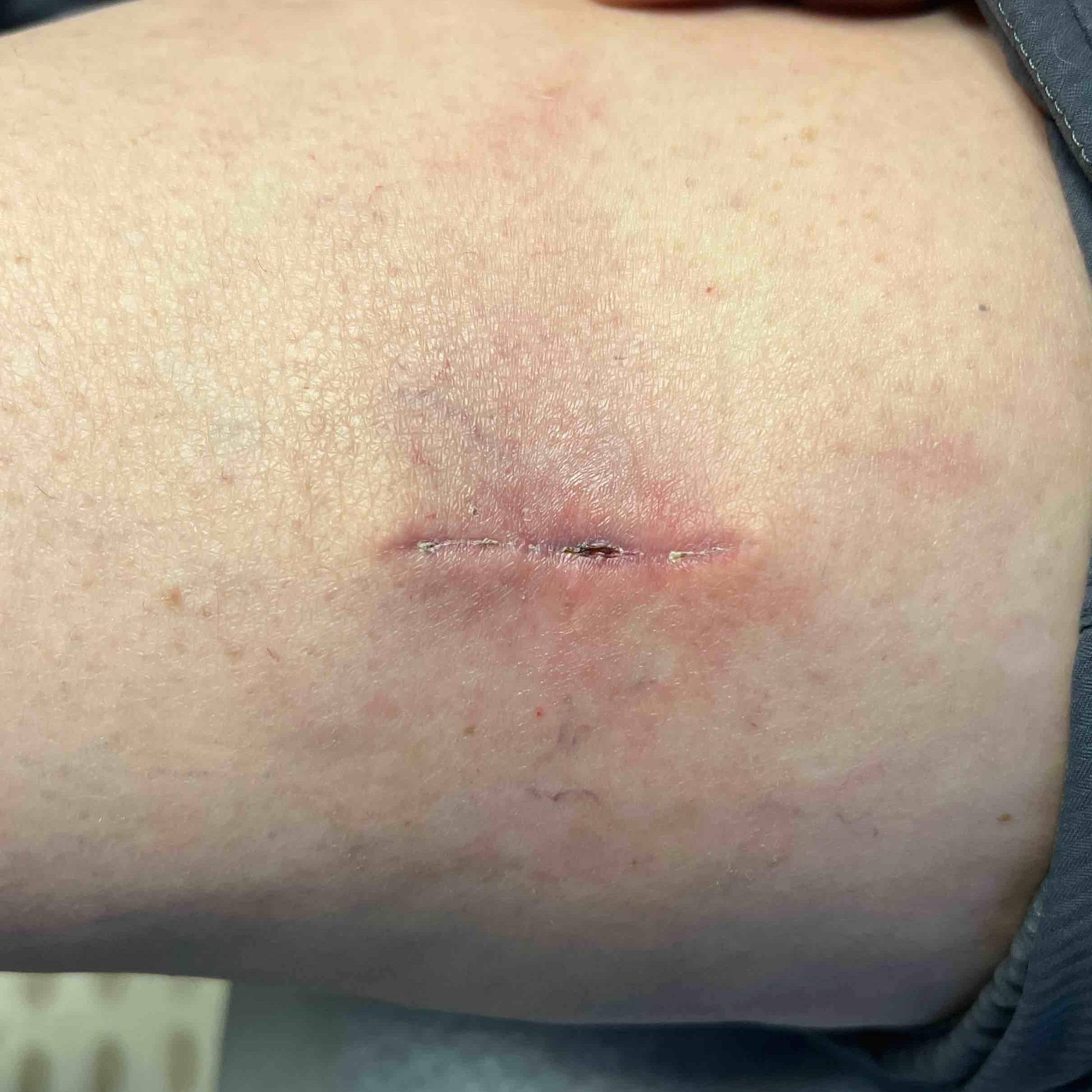 Cyst Removal Before and After Case-10 After