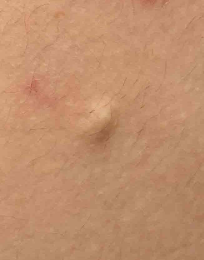 Cyst Removal Before and After Case-11 Before