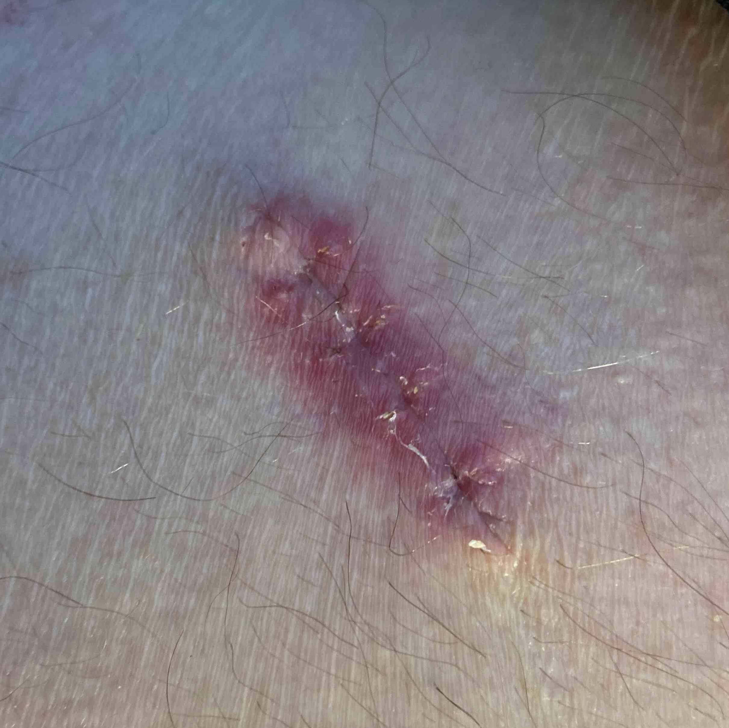 Cyst Removal Before and After Case-11 After