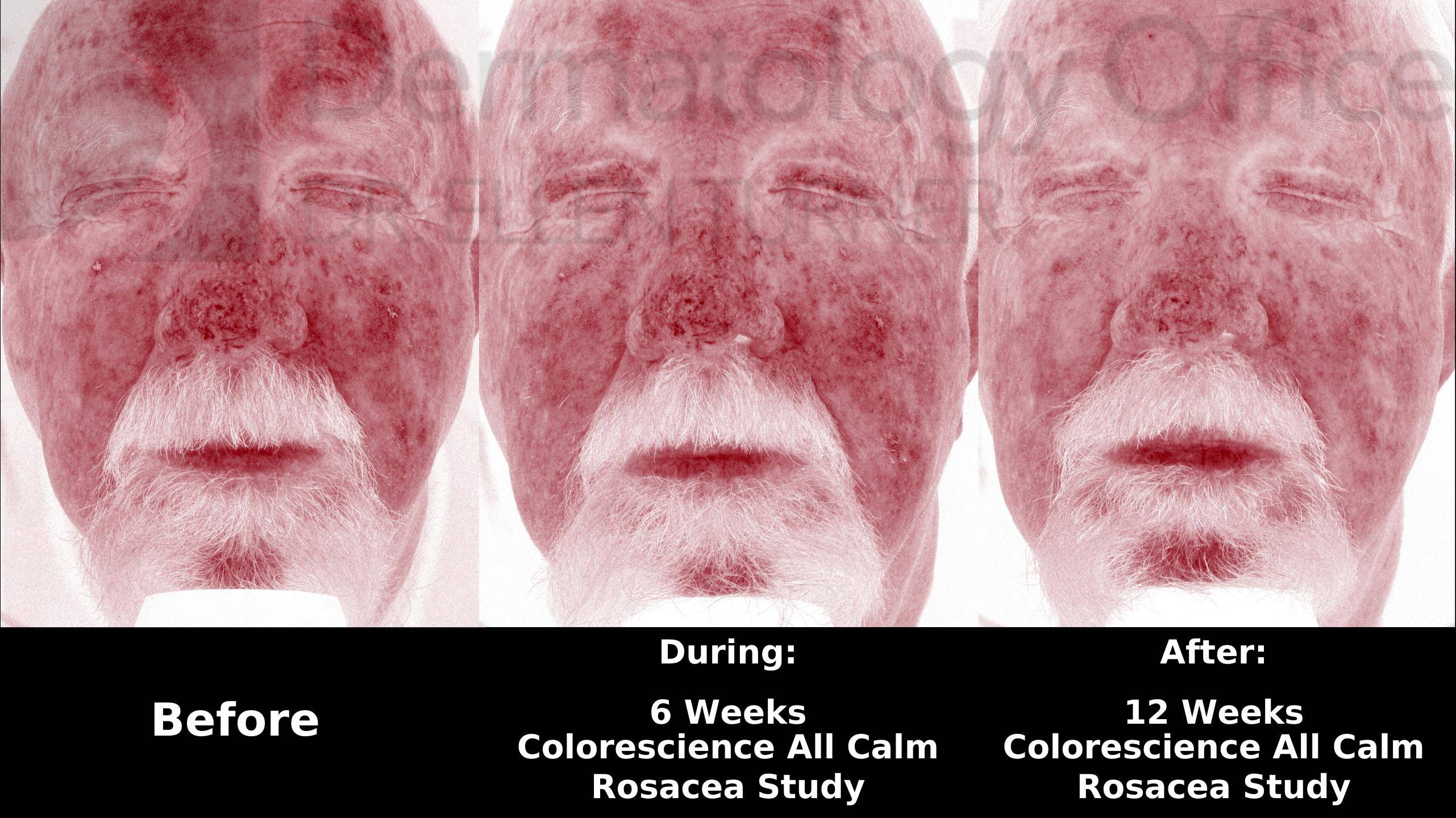 Colorescience Rosacea Study Case-8 