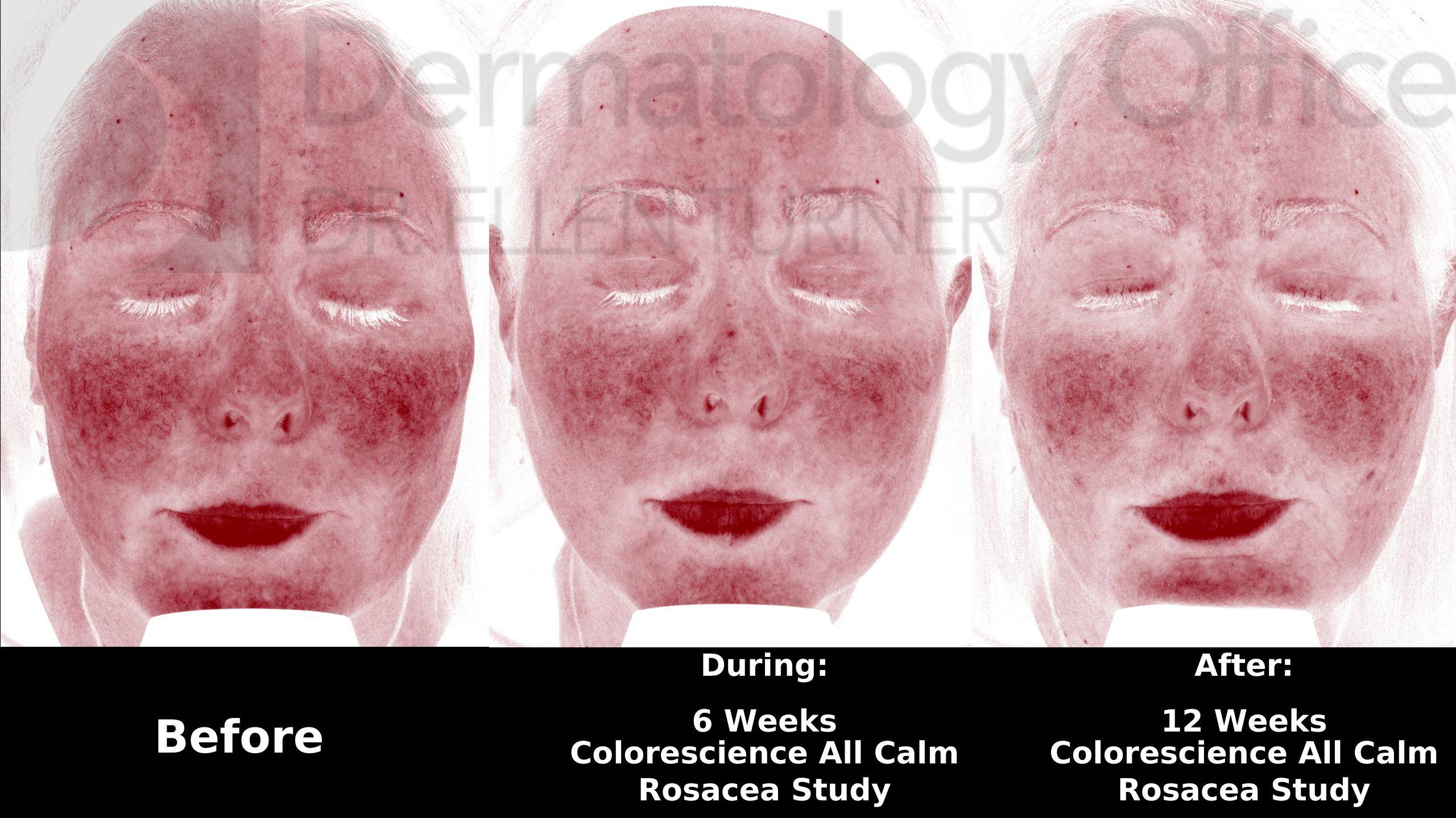 Colorescience Rosacea Study Case-9 