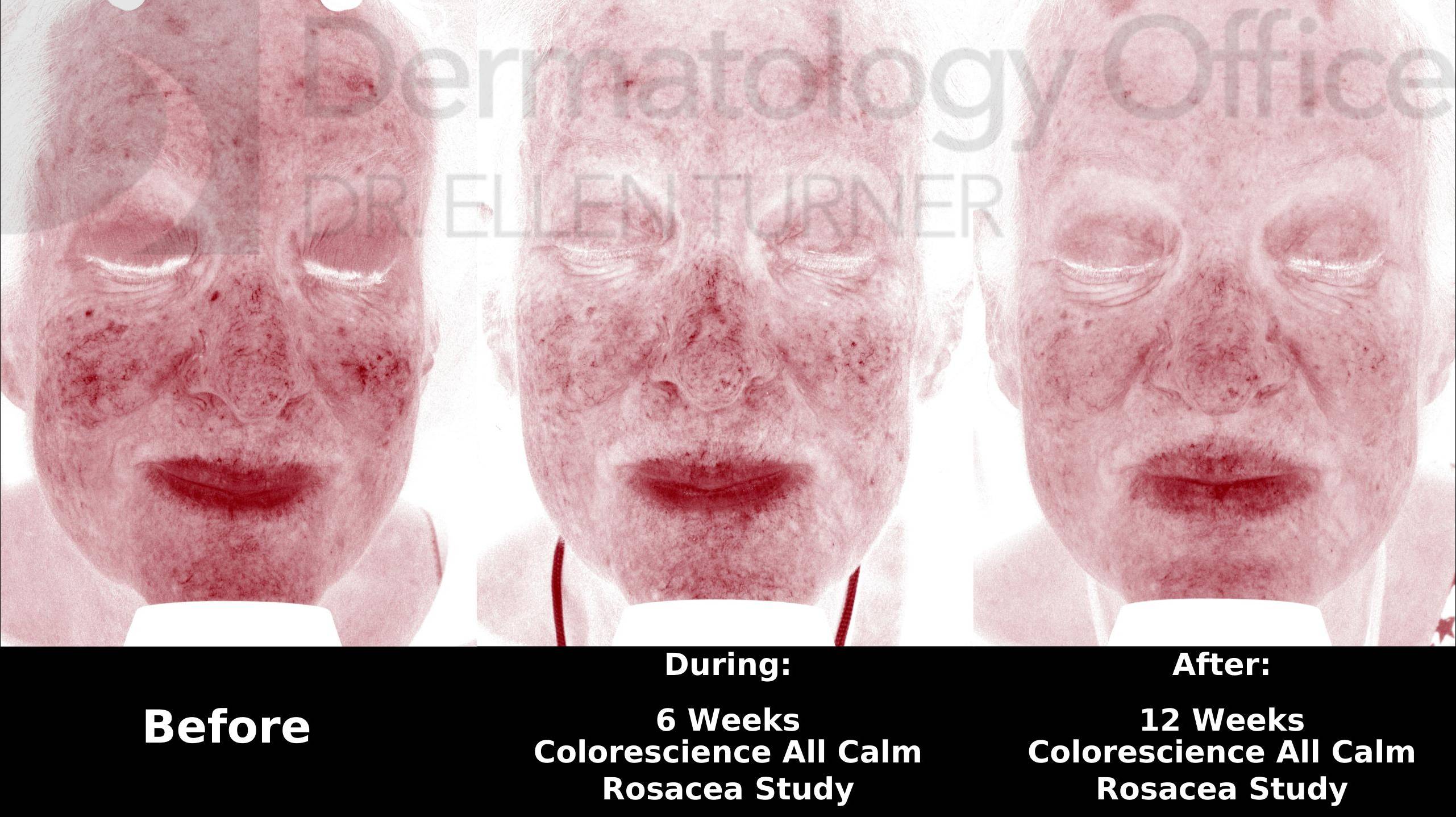 Colorescience Rosacea Study Case-12 