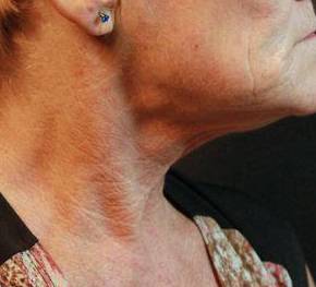 Ultherapy<sup>®</sup> Before and After Case 7 Before