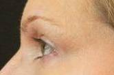 Ultherapy<sup>®</sup> Before and After Case 8 After