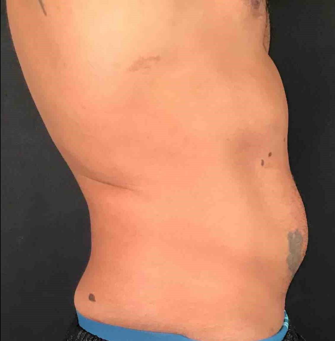 EMSculpt Neo (4 Treatments) Case-1 Before