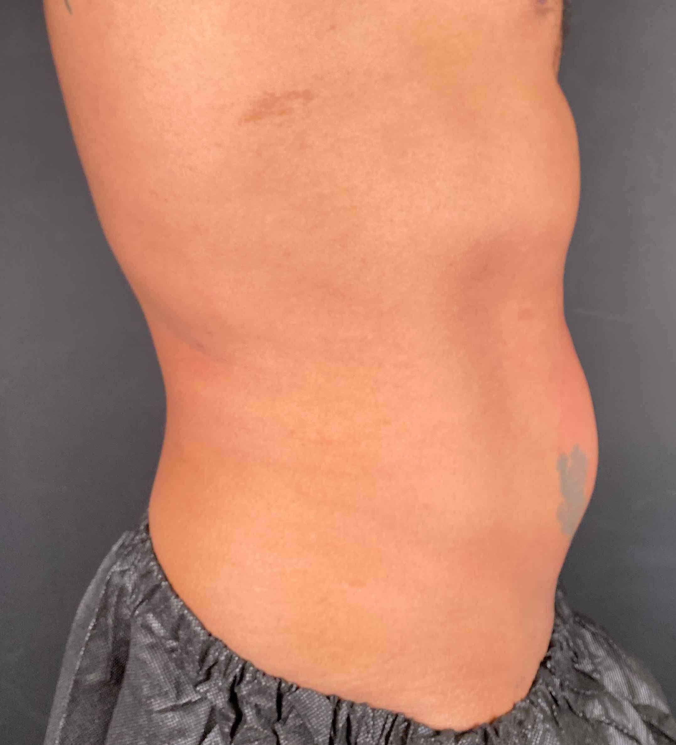 EMSculpt Neo (4 Treatments) Case-1 After