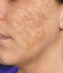 Fraxel<sup>®</sup> Before and After Case 5 Before
