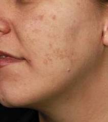 Fraxel<sup>®</sup> Before and After Case 5 After