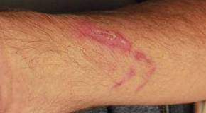 Fraxel<sup>®</sup> Before and After Case 6 Before