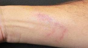 Fraxel<sup>®</sup> Before and After Case 6 After