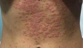 Psoriasis Before and After Case 1 Before