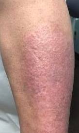 Psoriasis Before and After Case 2 After