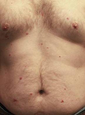 Psoriasis Before and After Case 3 Before