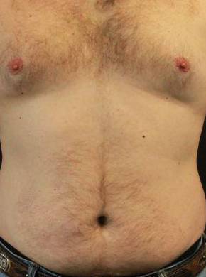 Psoriasis Before and After Case 3 After