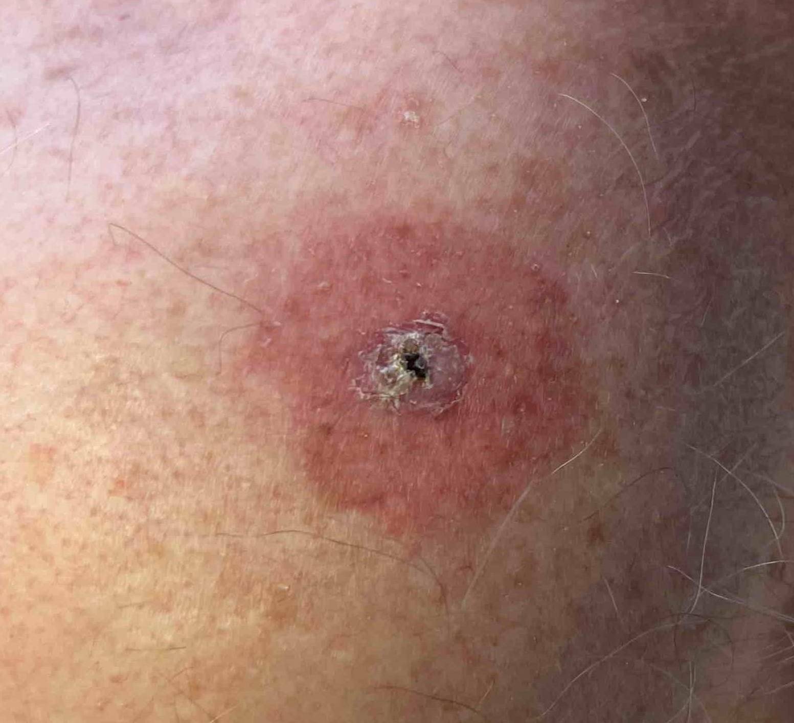 Skin Cancer (17 Radiation Treatment) Case-39 Before