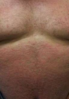 Psoriasis Before and After Case 4 Before
