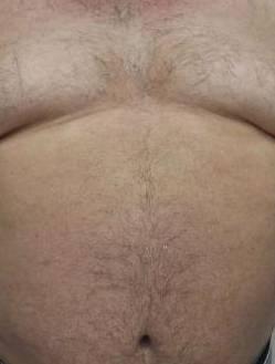 Psoriasis Before and After Case 4 After