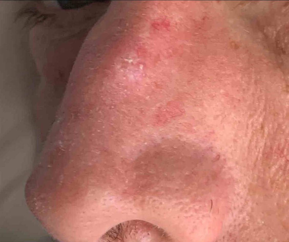 Skin Cancer (14 Treatments) Case-42 Before