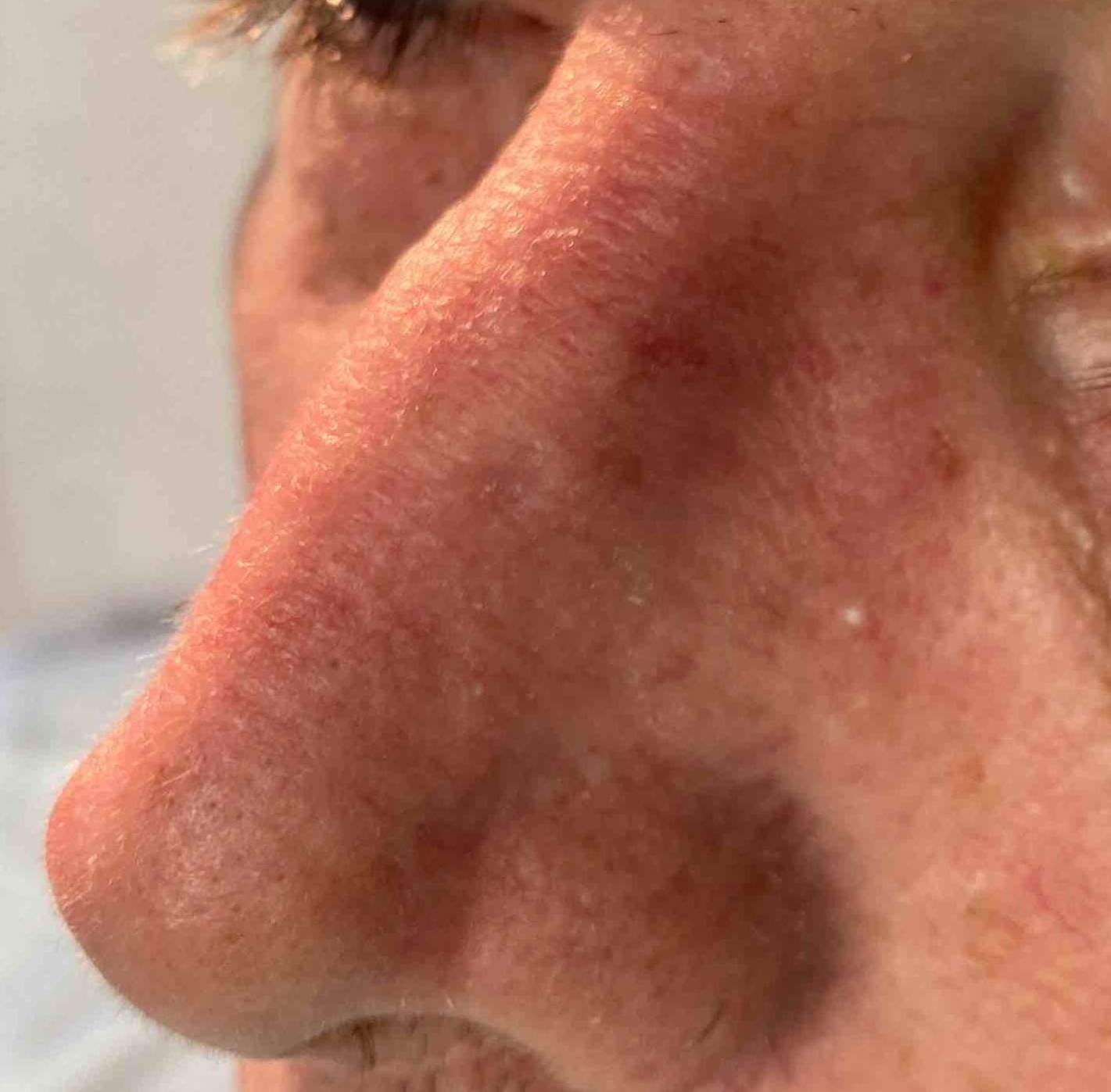 Skin Cancer (14 Treatments) Case-42 After