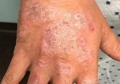Psoriasis Before and After Case 5 Before