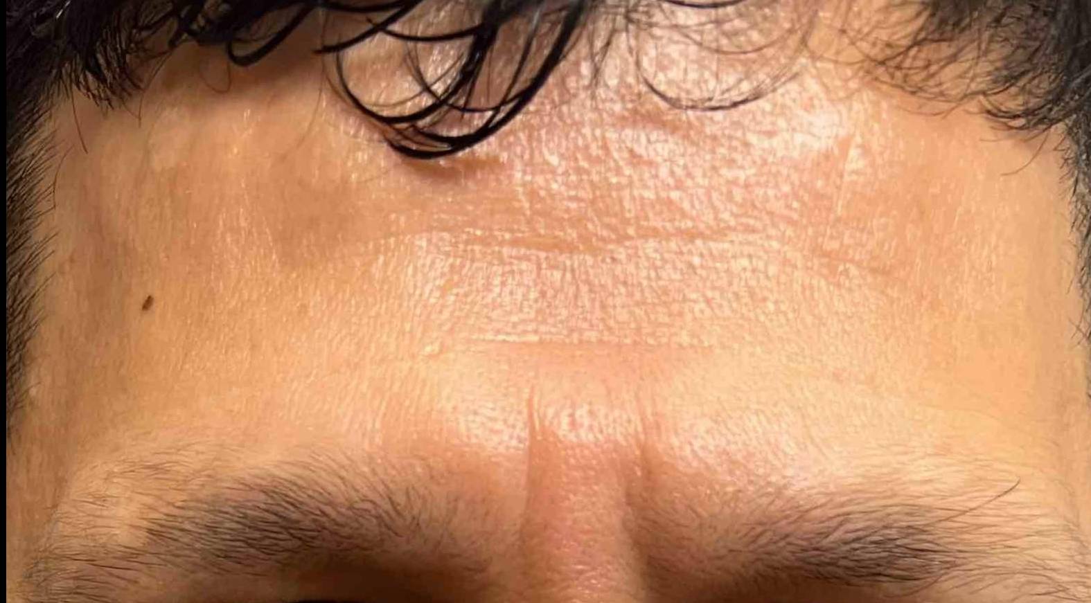 Botox (25 Units) Case-18 Before
