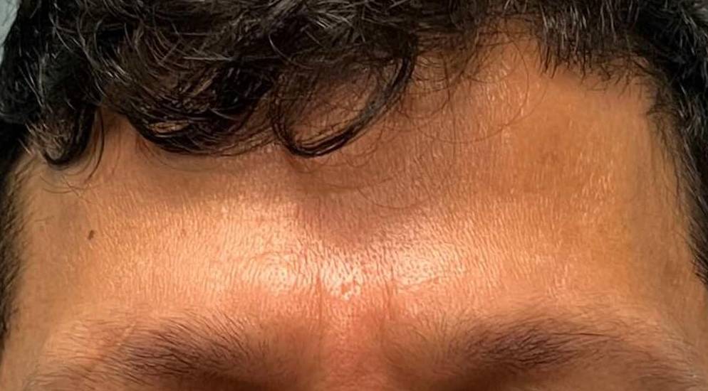 Botox (25 Units) Case-18 After