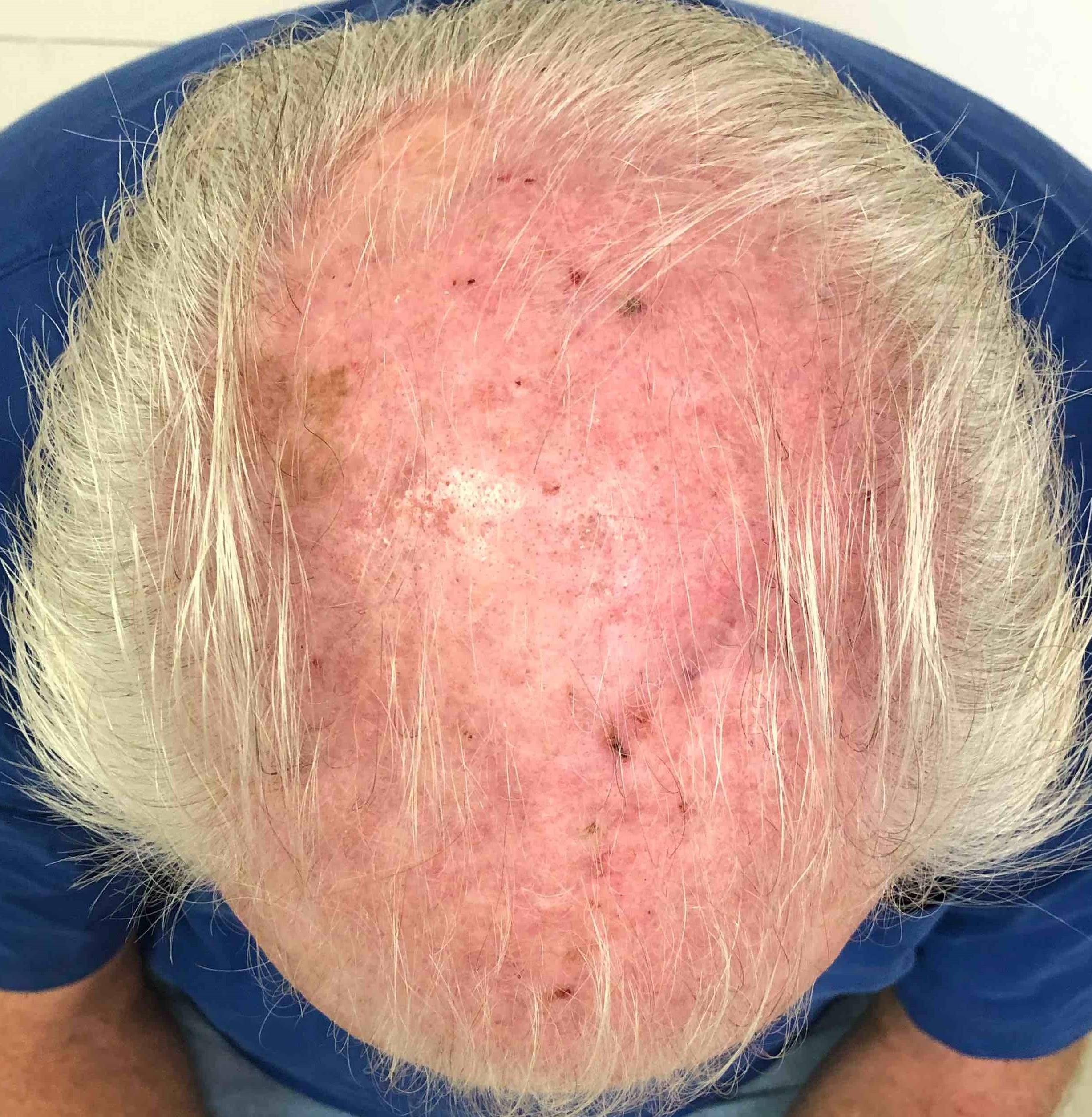 Actinic Keratosis Case-2 Before