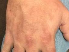 Psoriasis Before and After Case 5 After