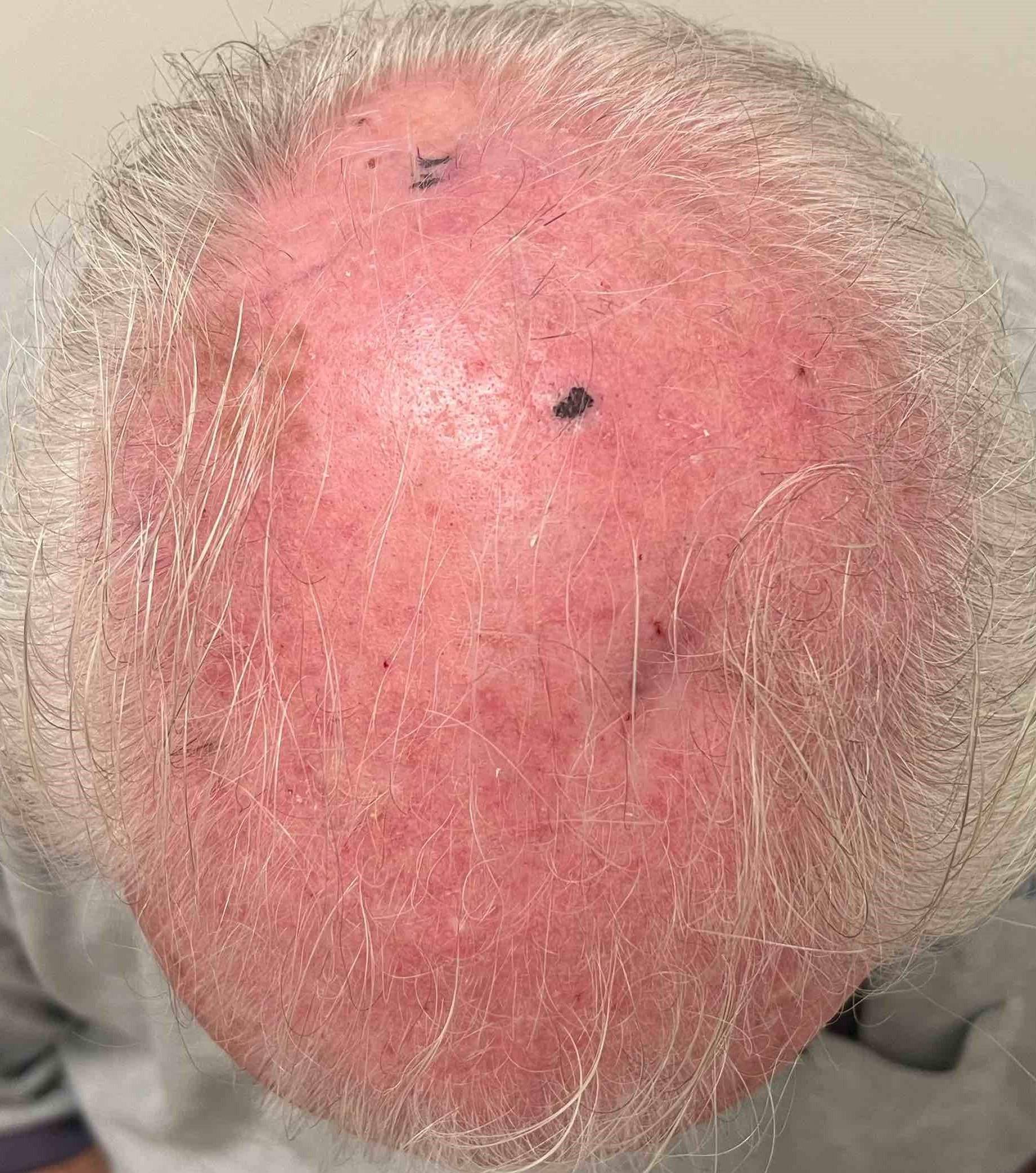 Actinic Keratosis Case-2 After